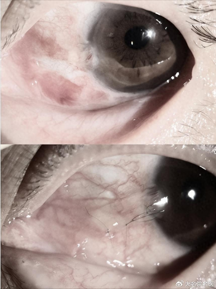 角膜及眼表专科的肖昭主任对杨先生的眼睛进行了急诊检查,诊断为左眼
