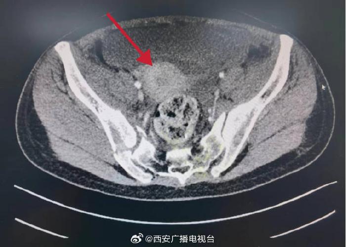 高處墜落盆腹腔積血介入治療控制住出血