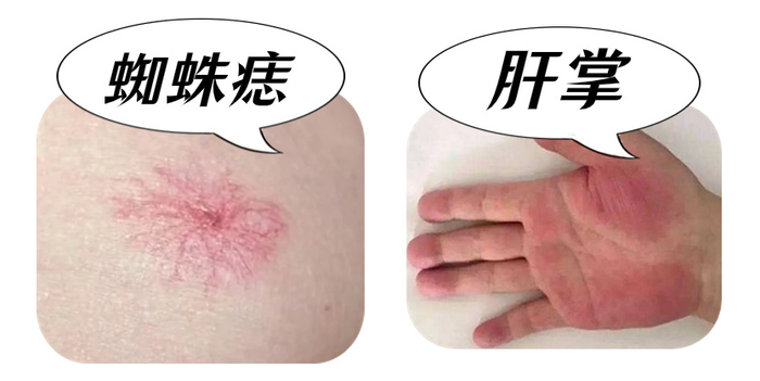 出现这些症状要小心→|肝炎|病毒性肝炎|肝脏_新浪新闻