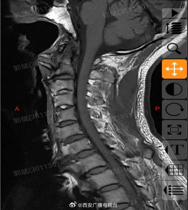 红会医院 | 穿越气道迷宫完成罕见食管型颈椎病麻醉|颈椎病|食管|食道