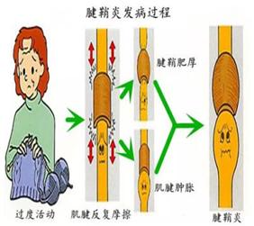 【浙一全科·科普】 腱鞘炎是怎么看上你的？