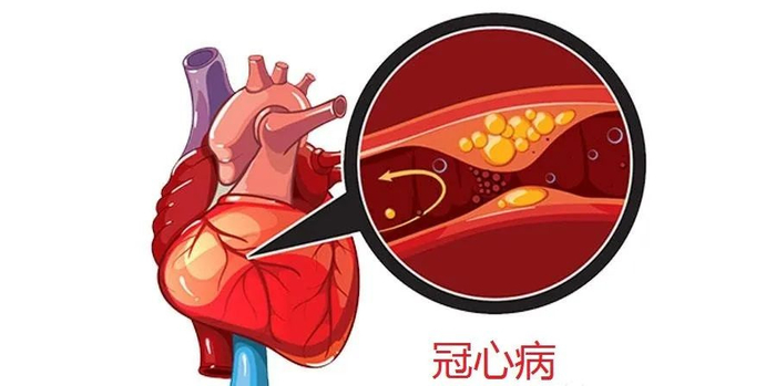 为什么冠心病容易在秋冬季出现