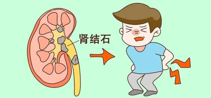有一种痛,叫肾结石痛!