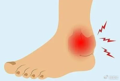 处理不及时常会发展为慢性踝关节不稳定,尤其是外侧踝关节不稳定常见.