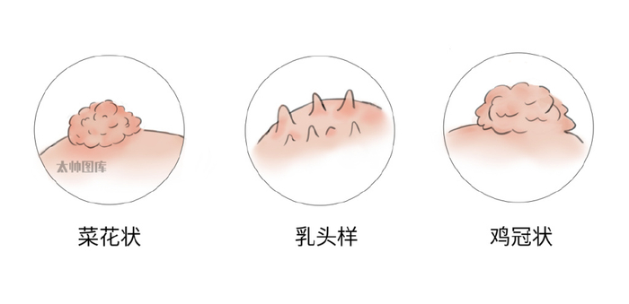 越抠越多!身上长的小疙瘩,或是hpv病毒感染