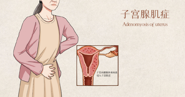 一种可能影响女性一生的疾病— —子宫腺肌症