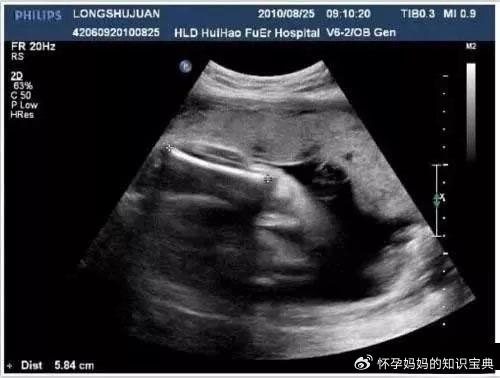 一张b超单数据教你怎么看出生男生女!方法很简单对比一下吧