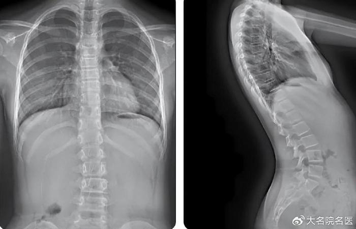 儿童腰椎反弓图片