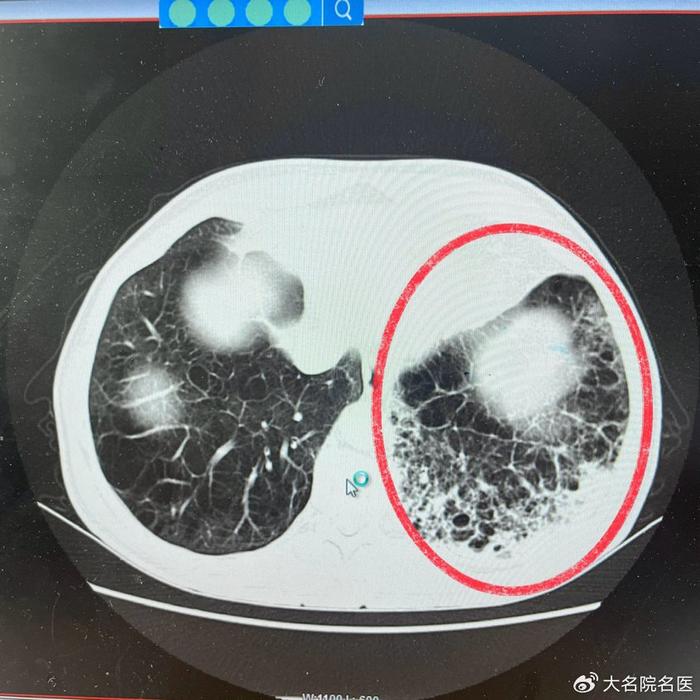 先天性大叶性肺气肿图片