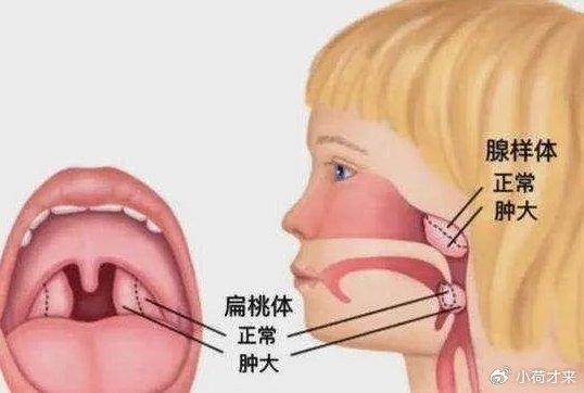 孩子腺樣體肥大睡覺張著嘴巴呼吸打呼嚕鼻塞憋醒家長可以用這妙招