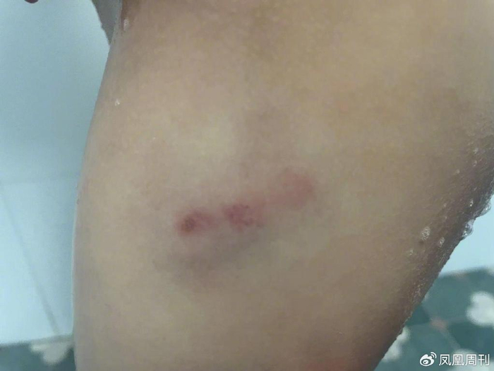 4岁男童被半米高黄狗咬伤后,狗主人否认咬人