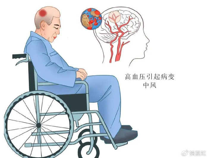 脑,耗氧量高且没有能量储备,对缺血缺氧十分敏感.