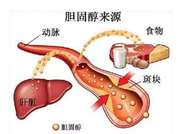 血脂异常:总胆固醇,低密度脂蛋白胆固醇,甘油三酯过高或高密度脂蛋白