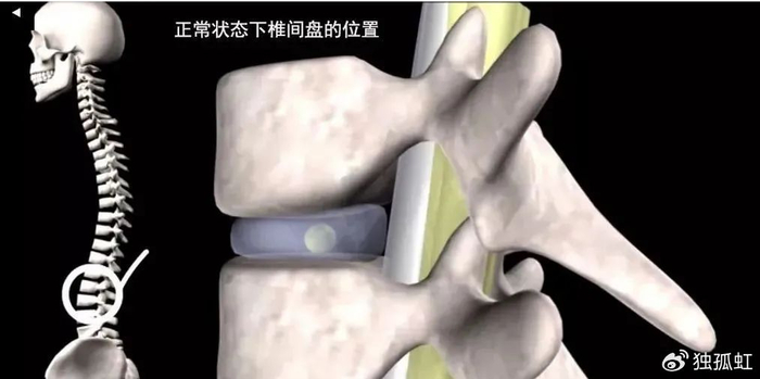 腰椎间盘突出千万不能做这个动作|仰卧起坐|腰椎|腰椎间盘突出_新浪新