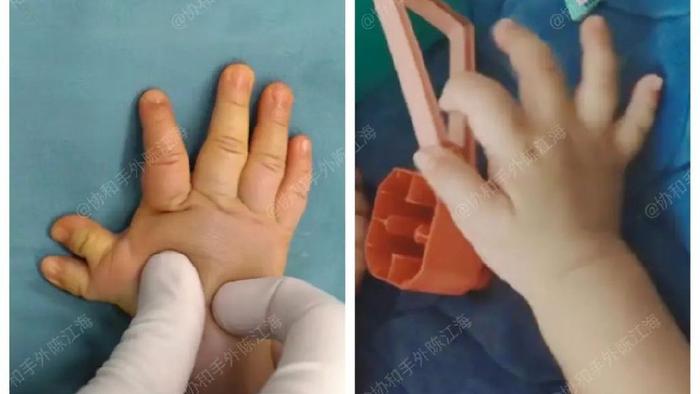 多指│案例5《宝宝多指，切里面还是切外面？其实还有这种做法！》