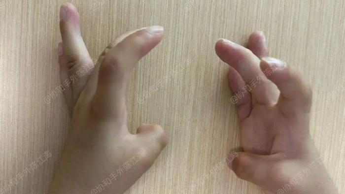 孩子双手伸不直愁坏妈妈，术后的心愿是养一只小猫咪！