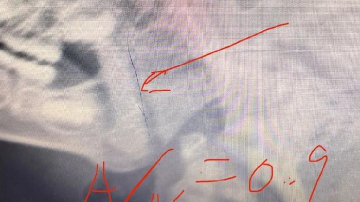 幼儿咳嗽咳痰3个月，最近睡觉憋醒，到底怎么啦？有必要手术吗？