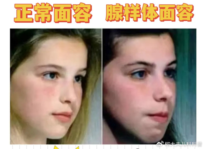 儿童腺样体肥大,为什么很多家长浑然不知,该不该手术治疗?