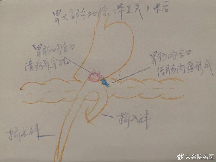 ":患者进食后,食物从胃直接进入大肠,未经小肠消化吸收就直接拉出来了