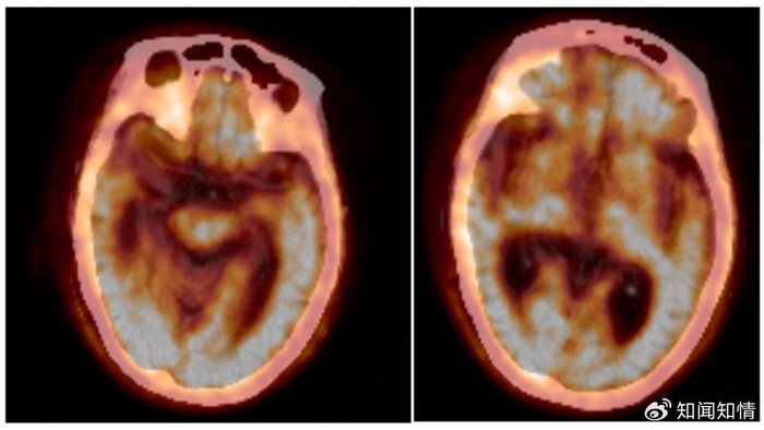泰安市中心医院成功开展阿尔茨海默病Aβ PET-CT脑显像__财经头条__新浪财经