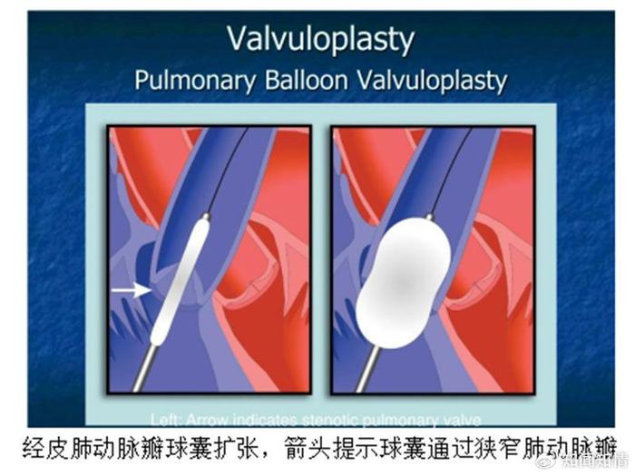 肺动脉瓣狭窄图片图片