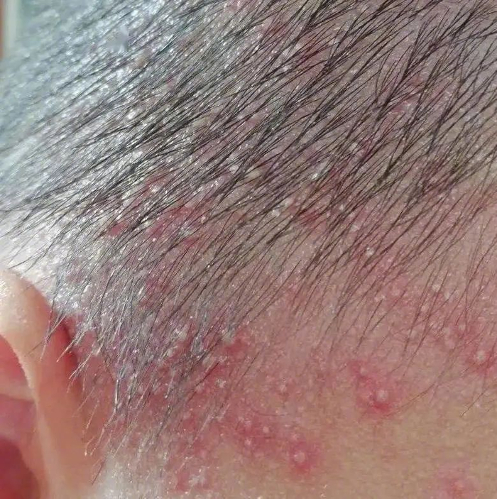 预防 护理一文说清,让娃少遭罪|痱子|湿疹|家长_新浪新闻