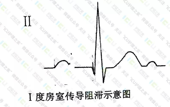 心电图读图五步法