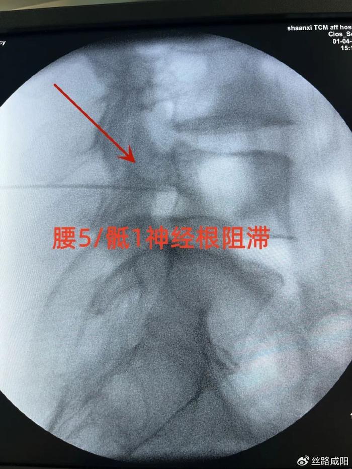 陕中附院 突出久不见好怎么办?阶梯治疗更适合您