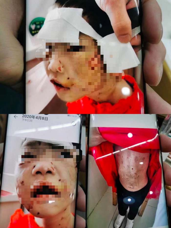 ▲4月8日，医护人员拍下的凡凡受伤照片。受访者供图