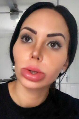 女子长得丑被人讽刺,花费190万元整容200次后,变成香肠嘴