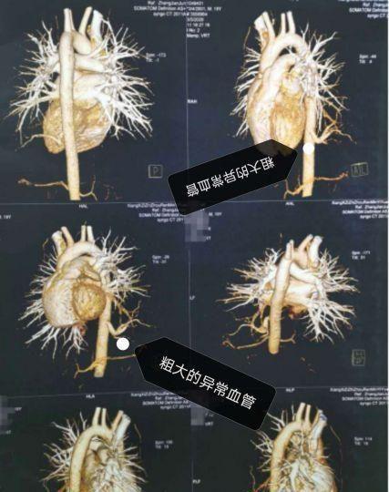 心胸外科成功实施胸腔镜下左下肺肺段隔离症手术