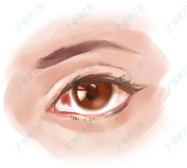 眼白出现黑斑怎么回事 白眼球有黑斑怎么消除