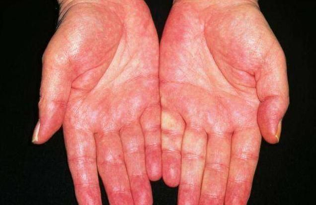 这两个部位"越红",说明血液越黏稠,发现就不要拖,尽早清血管