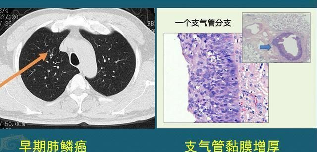 肺鳞癌是怎么发生的？怎样早期发现？医生教你看CT片|癌细胞_新浪新闻