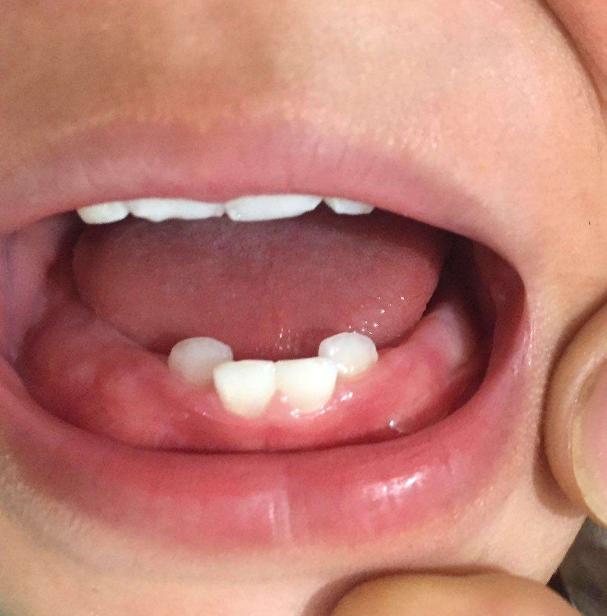 婴儿正常牙龈图片