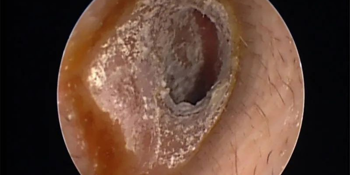 小伙采耳后,耳朵里竟然"发霉了"!