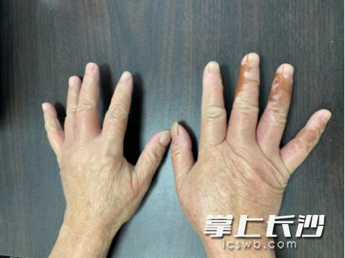 △捡拾白果后，刘女士双手长出不规则的棕色印记