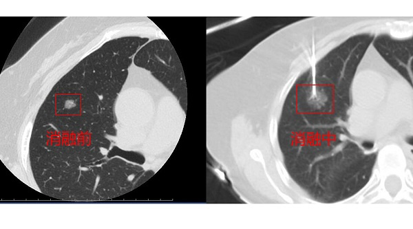 图说：上海市胸科医院“一针”射频消融，为多原发性肺癌患者解疑难 来源/采访对象提供