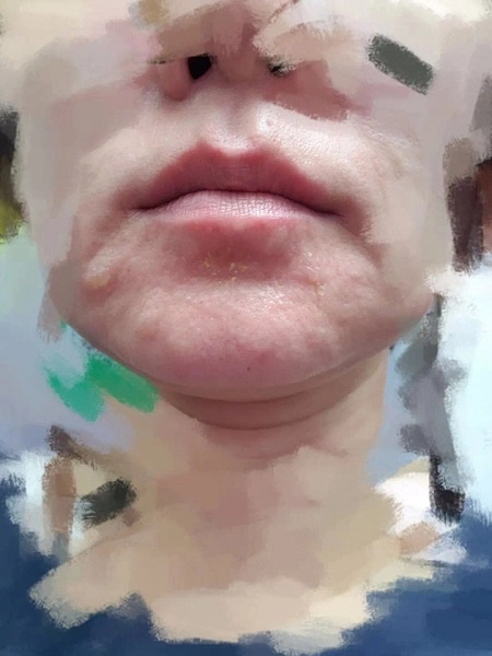 图说：林女士的脸因过敏红肿起泡（图片可能会带来不适）