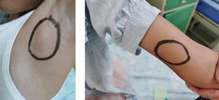 △当时出现硬块的位置