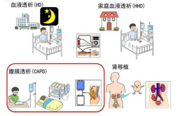 认识腹膜透析|慢性肾衰竭_新浪新闻