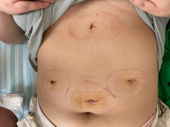 ▲艾美丽手术4天后，换药时拍下的创面照片。受访者供图