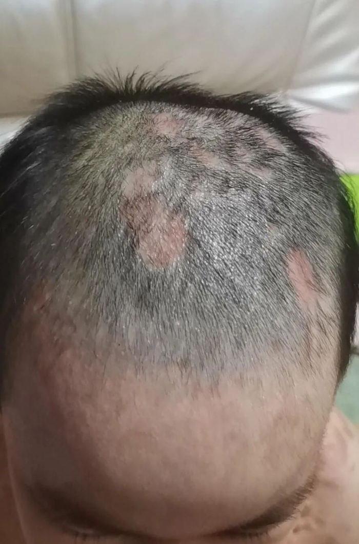 ▲正在康复中的童童。受访者供图