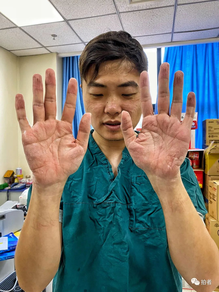 ▲2020年2月26日，武汉协和医院西院区，进入隔离病区拍摄新冠肺炎产妇生产4小时后，脸和手被防护服勒出深深的印记。