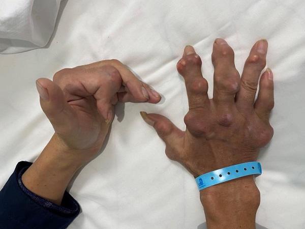 图说：患者手已经被痛风石“攻占” 来源/采访对象供图