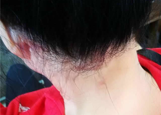 图为染发后李女士头部出现红斑肿块