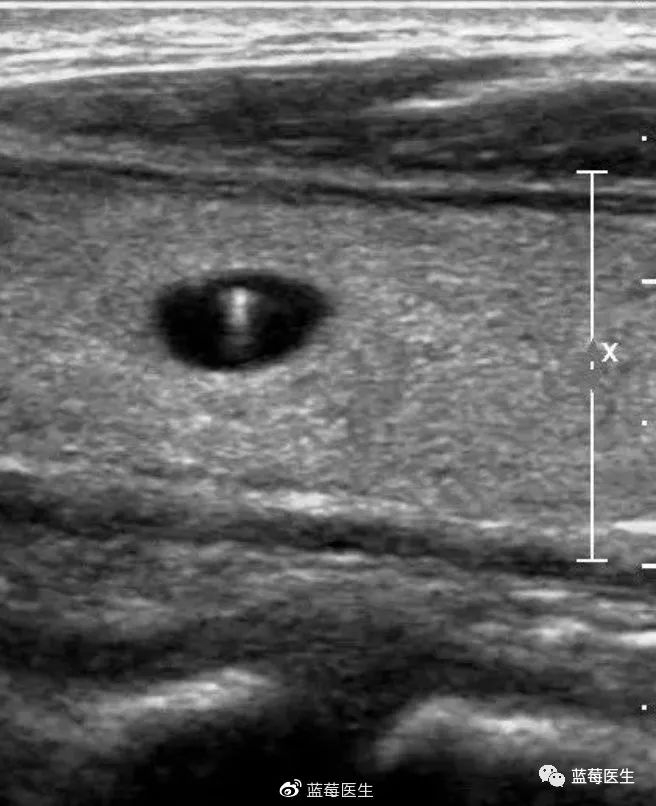 2020年末胰腺实性假乳头状瘤集中营，手术宜保留最多的正常胰腺