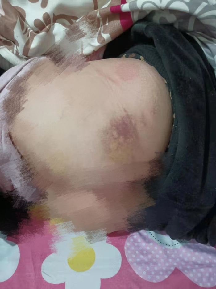 小娟身上有多处淤青。