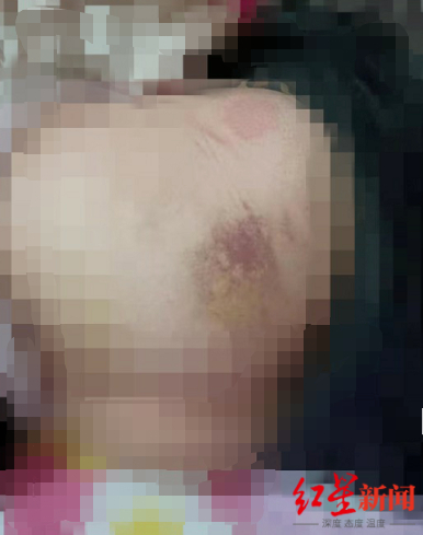 小娟身上多处淤青。图片来源：红星新闻