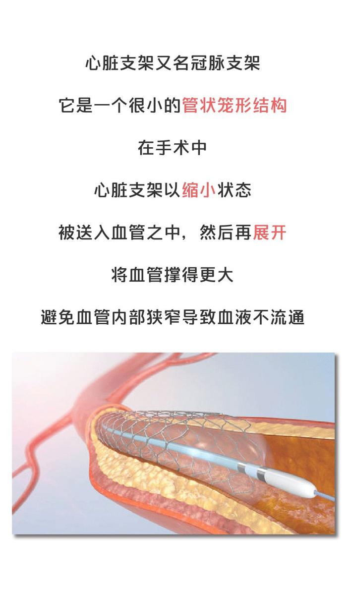 心脏支架从1.3万降至700元，原来医疗器械可以这么暴利？？？